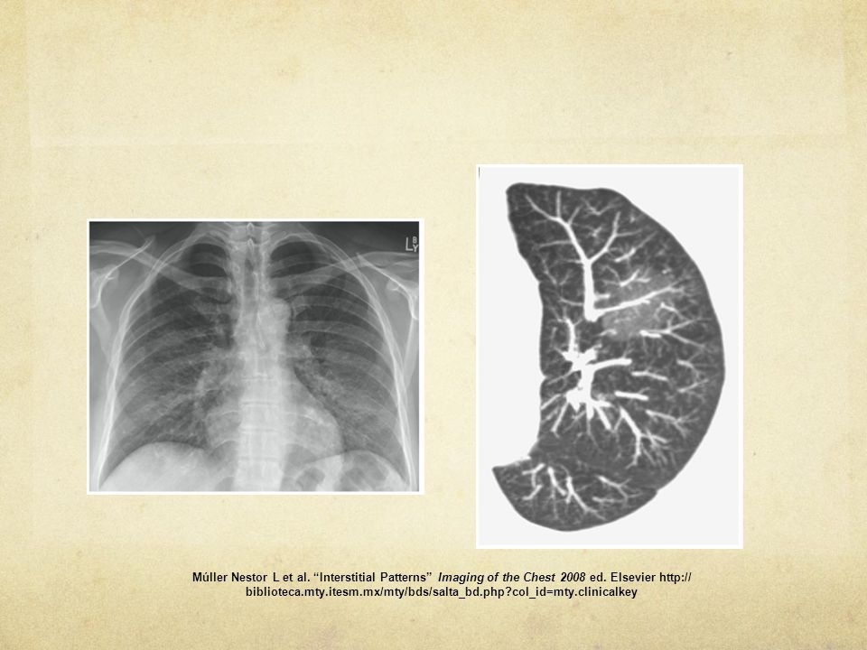 Múller Nestor L et al. Interstitial Patterns Imaging of the Chest 2008 ed.