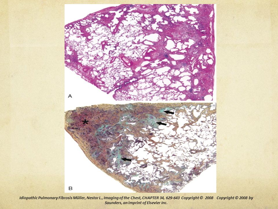 Áreas de inflamación intersticial que consisten principalmente de linfocitos y células plasmáticas asociadas con hiperplasia de neumocitos tipo 2, y del epitelio bronquiolar, las zonas fibróticas se encuentran compuestas principalmente por colágeno, y focos proliferativos subepiteliales de fibroblastos y miofibroblastos.