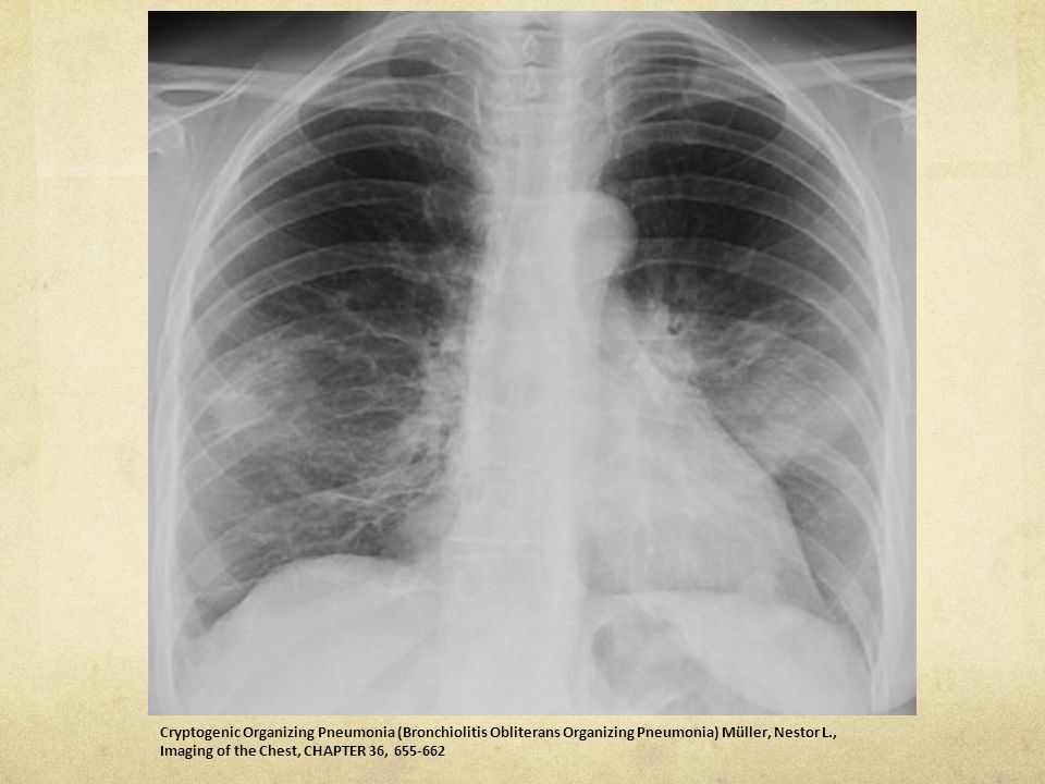 Cryptogenic Organizing Pneumonia (Bronchiolitis Obliterans Organizing Pneumonia) Müller, Nestor L., Imaging of the Chest, CHAPTER 36,