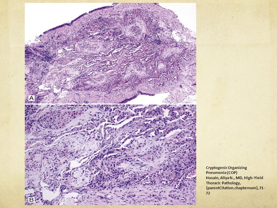 Fibrosis activa que involucra los lumenes y espacios peribronquiolares formando tapones de moco (Cuerpos de Masson), compuestos de miofibroblastos y fibroblastos alrededor de tejido conectivo no denso