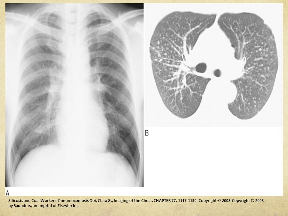 Silicosis. A 68-year-old construction site worker with simple silicosis. A , Posteroanterior chest radiograph showing multiple small diffuse nodules with some lower zone sparing. B , Spiral CT scan (10-mm thickness) showing well-defined nodules, 2-5 mm, predominantly in a centrilobular and subpleural distribution.