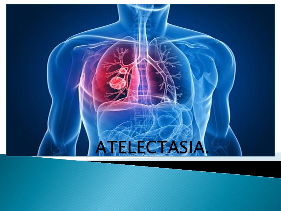 ATELECTASIA.