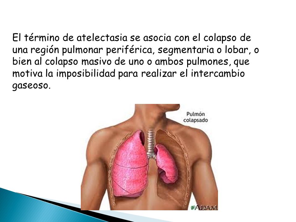 El término de atelectasia se asocia con el colapso de una región pulmonar periférica, segmentaria o lobar, o bien al colapso masivo de uno o ambos pulmones, que motiva la imposibilidad para realizar el intercambio gaseoso.