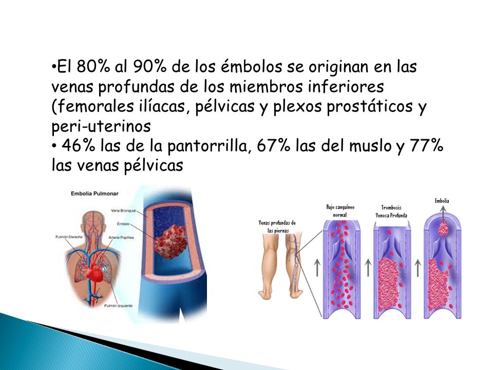 El 80% al 90% de los émbolos se originan en las venas profundas de los miembros inferiores (femorales ilíacas, pélvicas y plexos prostáticos y peri-uterinos