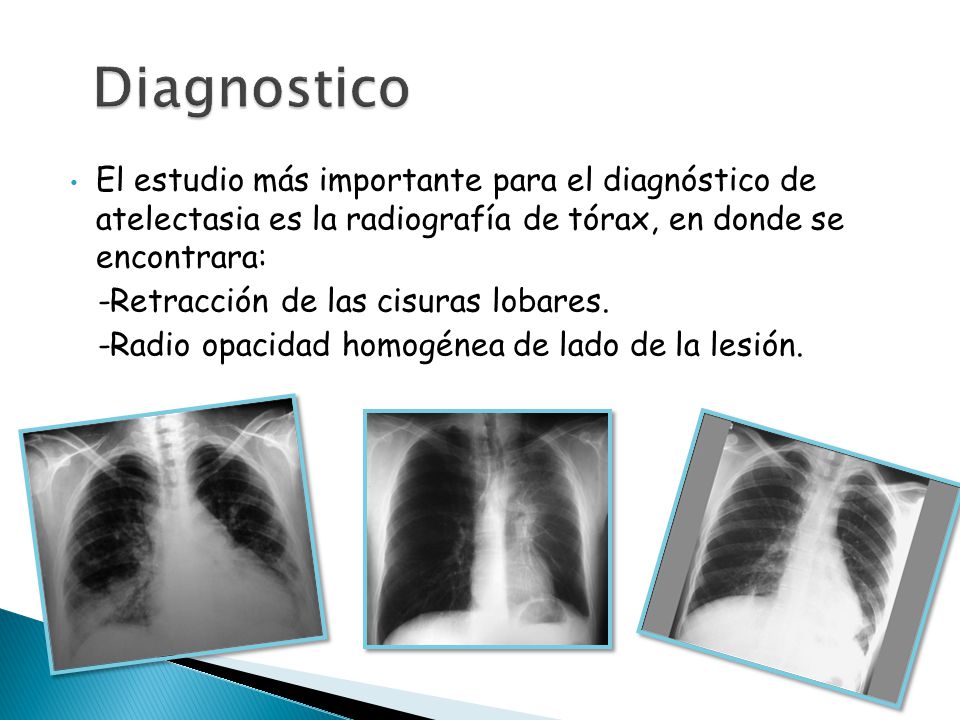 Diagnostico El estudio más importante para el diagnóstico de atelectasia es la radiografía de tórax, en donde se encontrara: