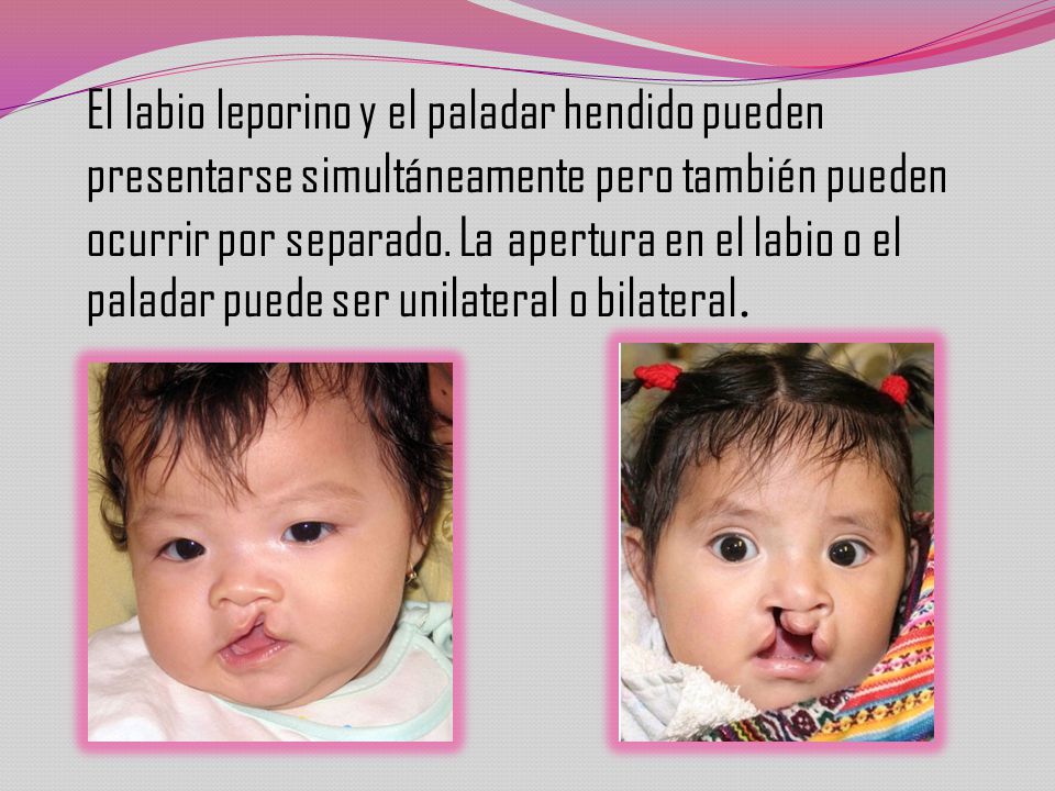 El labio leporino y el paladar hendido pueden presentarse simultáneamente pero también pueden ocurrir por separado.