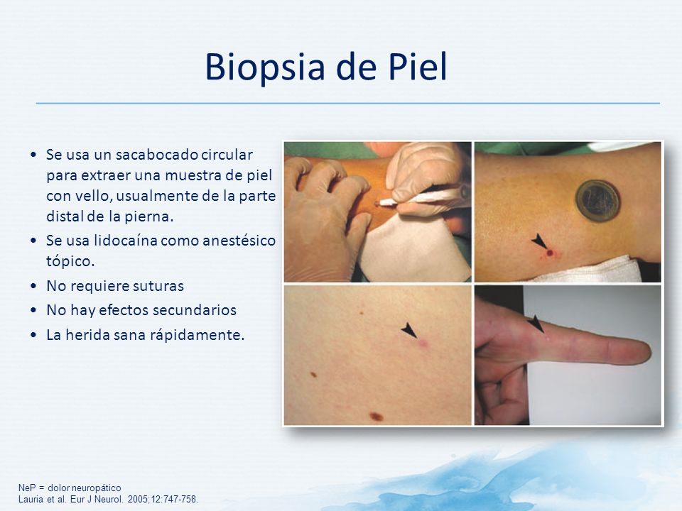 Biopsia de Piel Se usa un sacabocado circular para extraer una muestra de piel con vello, usualmente de la parte distal de la pierna.