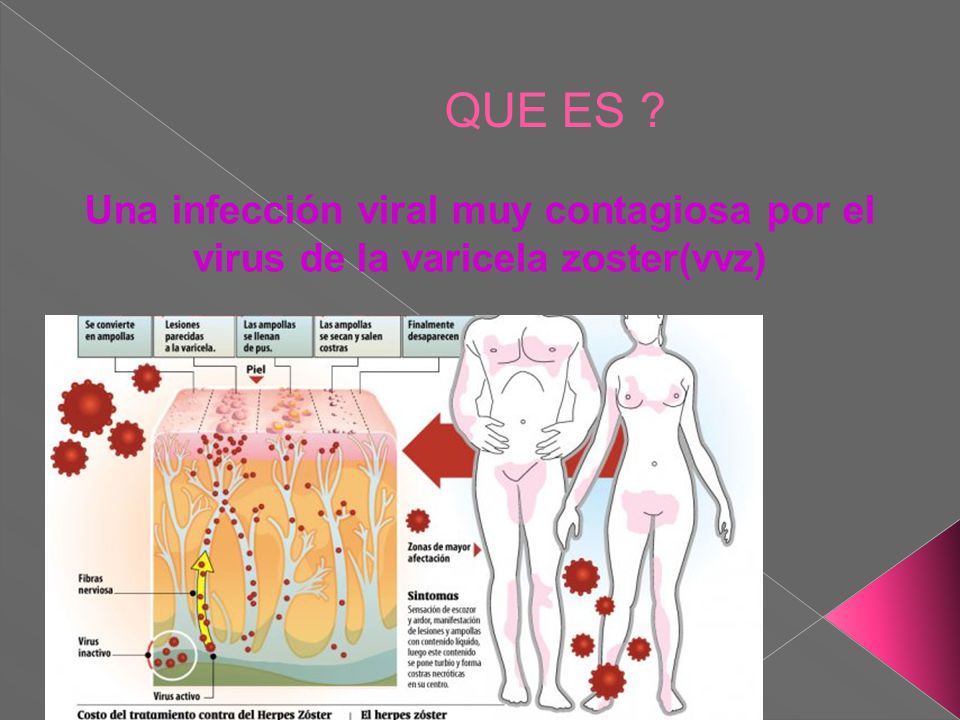 QUE ES Una infección viral muy contagiosa por el virus de la varicela zoster(vvz)