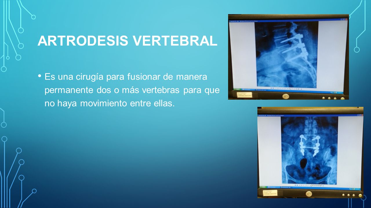 Artrodesis vertebral Es una cirugía para fusionar de manera permanente dos o más vertebras para que no haya movimiento entre ellas.