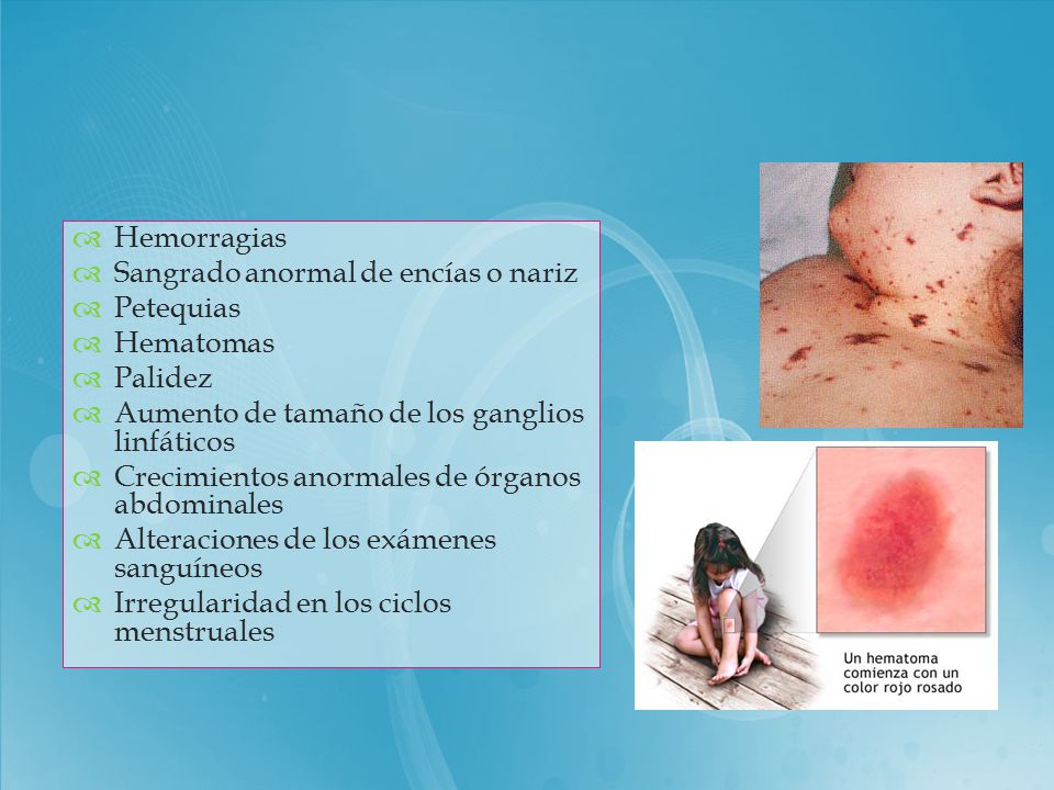 Hemorragias Sangrado anormal de encías o nariz. Petequias. Hematomas. Palidez. Aumento de tamaño de los ganglios linfáticos.