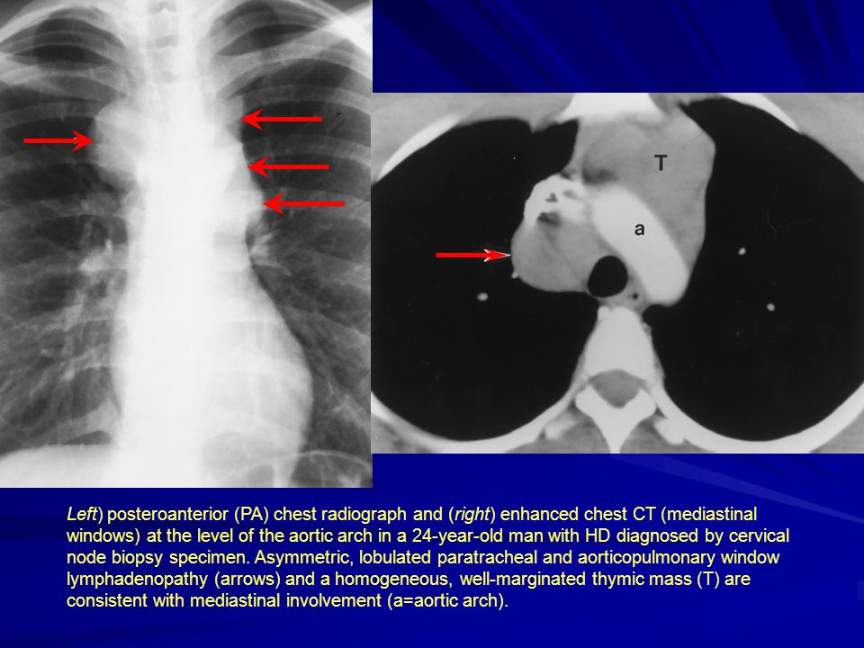 Left) posteroanterior (PA) chest radiograph and (right) enhanced chest CT (mediastinal windows) at the level of the aortic arch in a 24-year-old man with HD diagnosed by cervical node biopsy specimen.