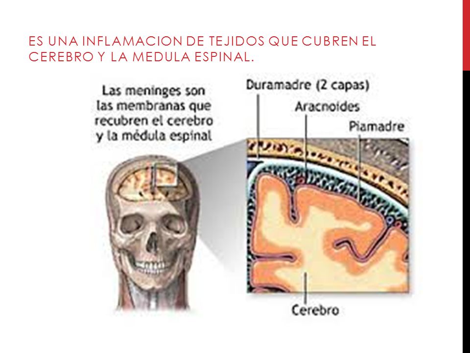 ES una inflamacion de tejidos que cubren el cerebro y la medula espinal.