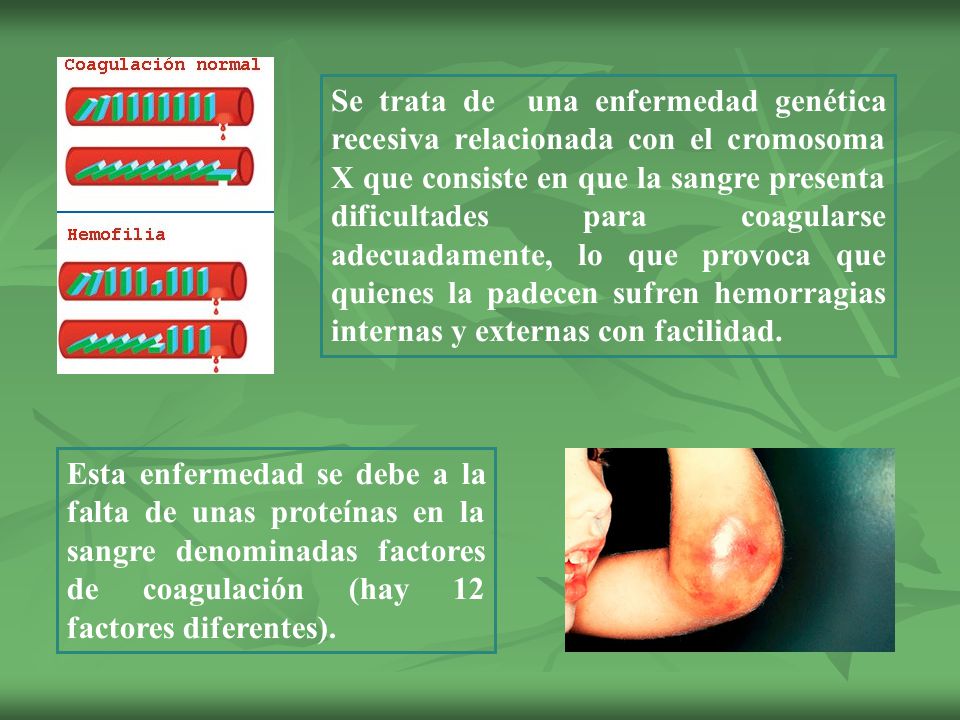 Se trata de una enfermedad genética recesiva relacionada con el cromosoma X que consiste en que la sangre presenta dificultades para coagularse adecuadamente, lo que provoca que quienes la padecen sufren hemorragias internas y externas con facilidad.
