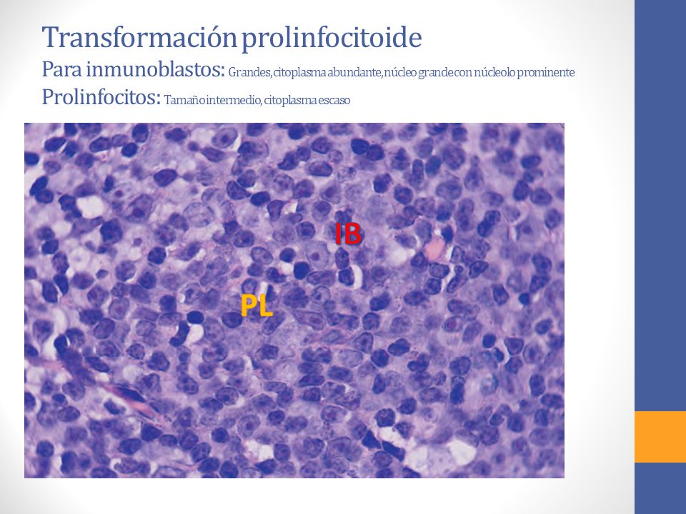 Transformación prolinfocitoide Para inmunoblastos: Grandes, citoplasma abundante, núcleo grande con núcleolo prominente Prolinfocitos: Tamaño intermedio, citoplasma escaso