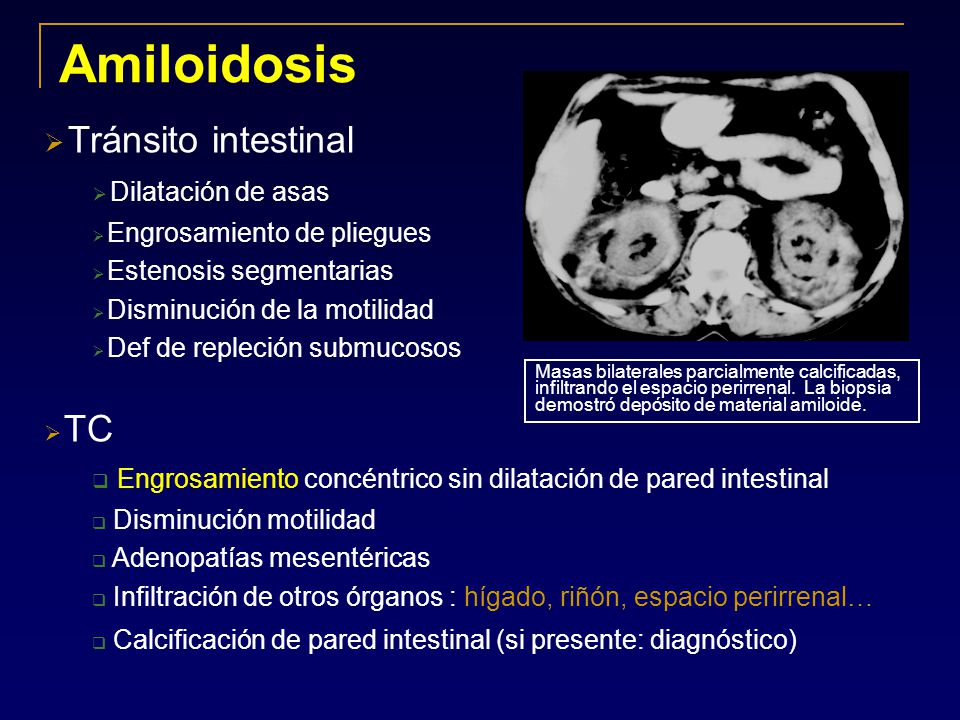 Amiloidosis Tránsito intestinal TC Dilatación de asas