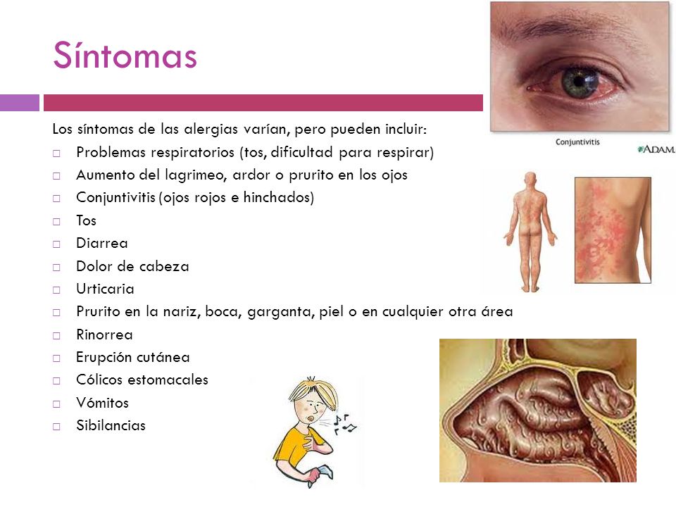 Síntomas Los síntomas de las alergias varían, pero pueden incluir:
