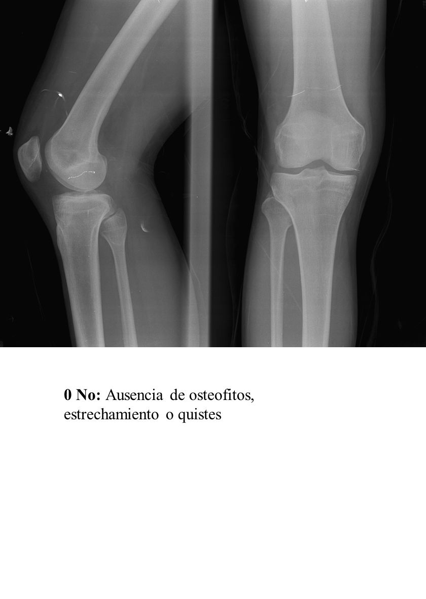 0 No: Ausencia de osteofitos, estrechamiento o quistes
