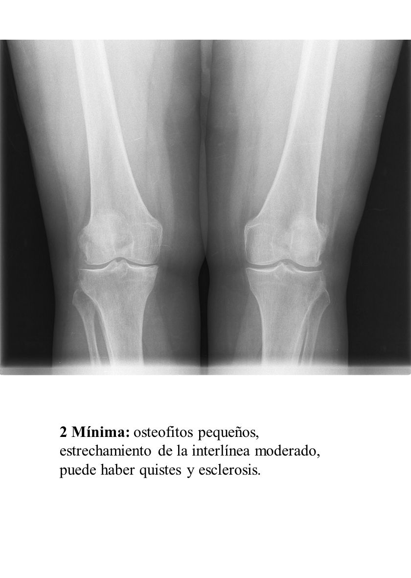 2 Mínima: osteofitos pequeños, estrechamiento de la interlínea moderado, puede haber quistes y esclerosis.