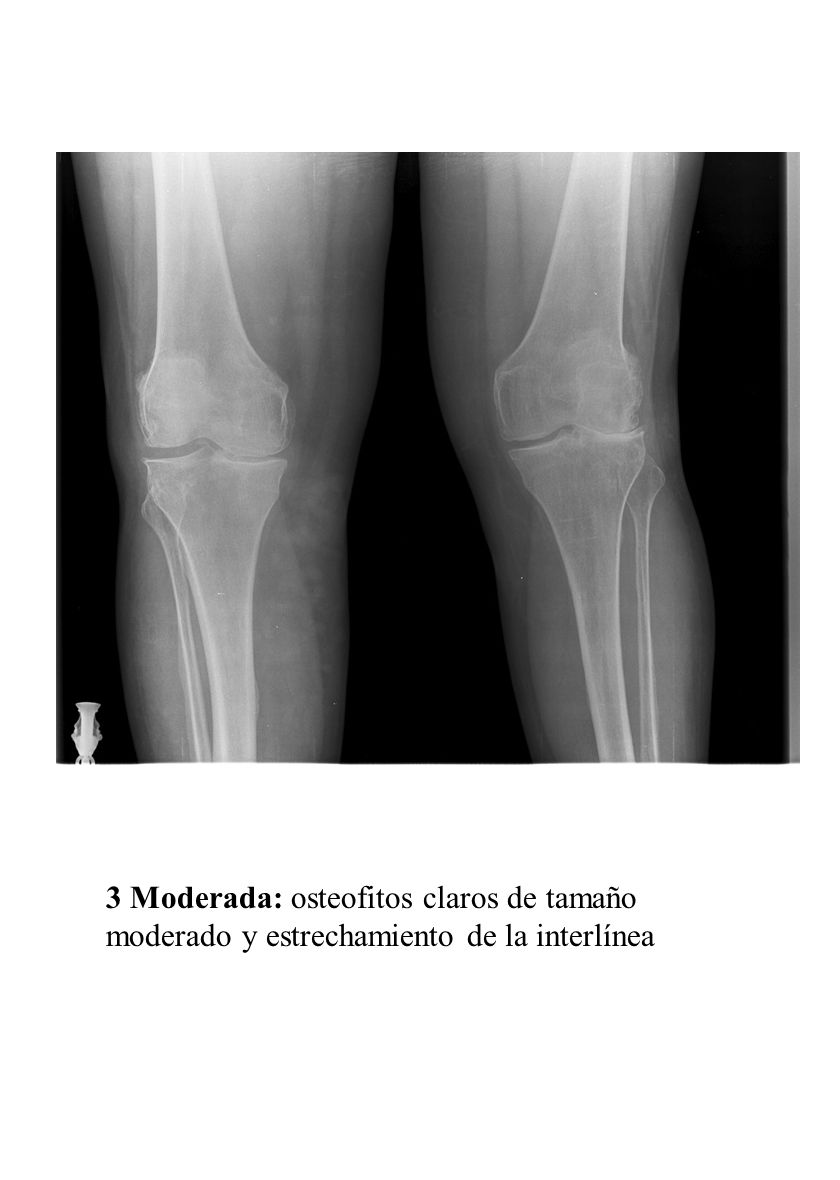 3 Moderada: osteofitos claros de tamaño moderado y estrechamiento de la interlínea
