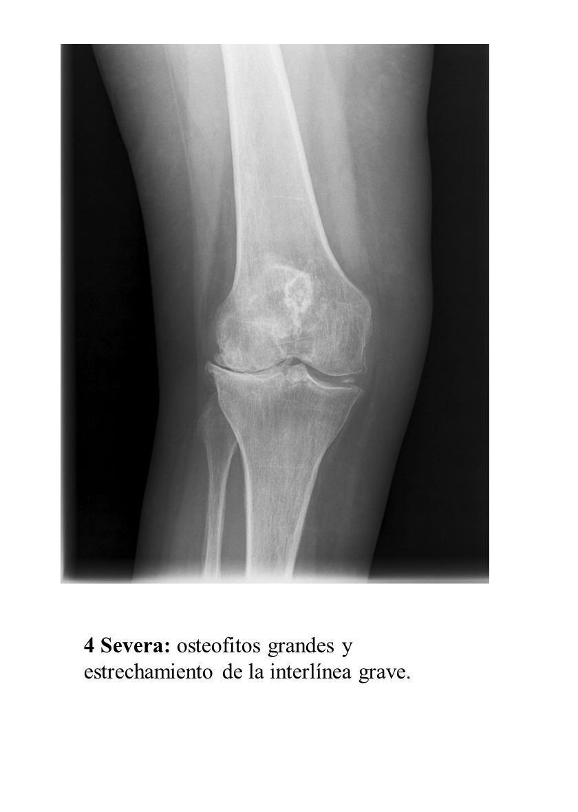 4 Severa: osteofitos grandes y estrechamiento de la interlínea grave.