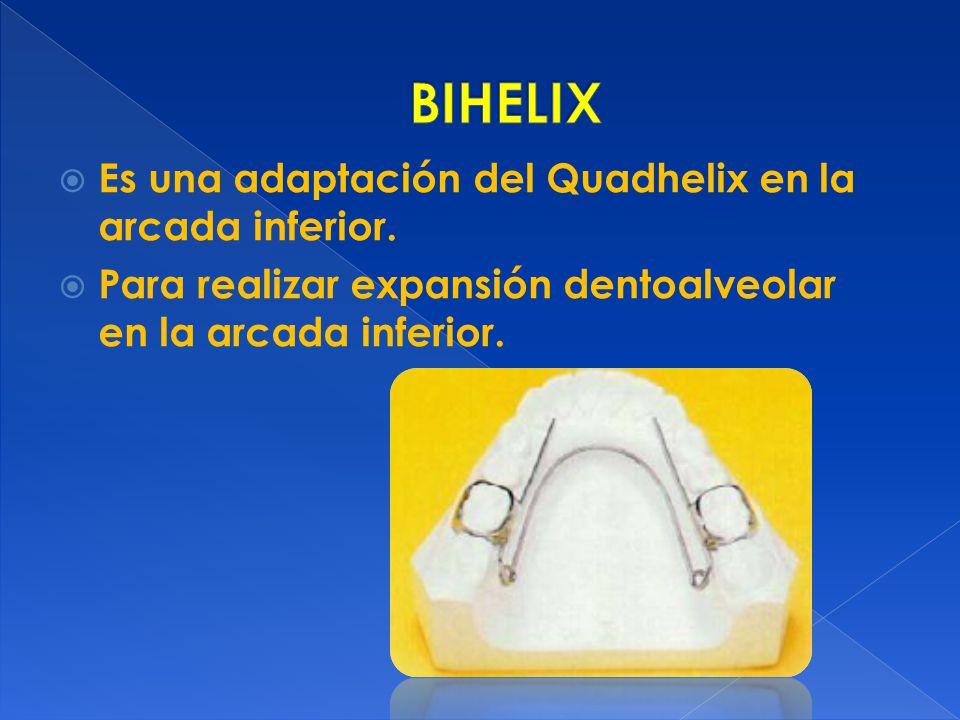 BIHELIX Es una adaptación del Quadhelix en la arcada inferior.