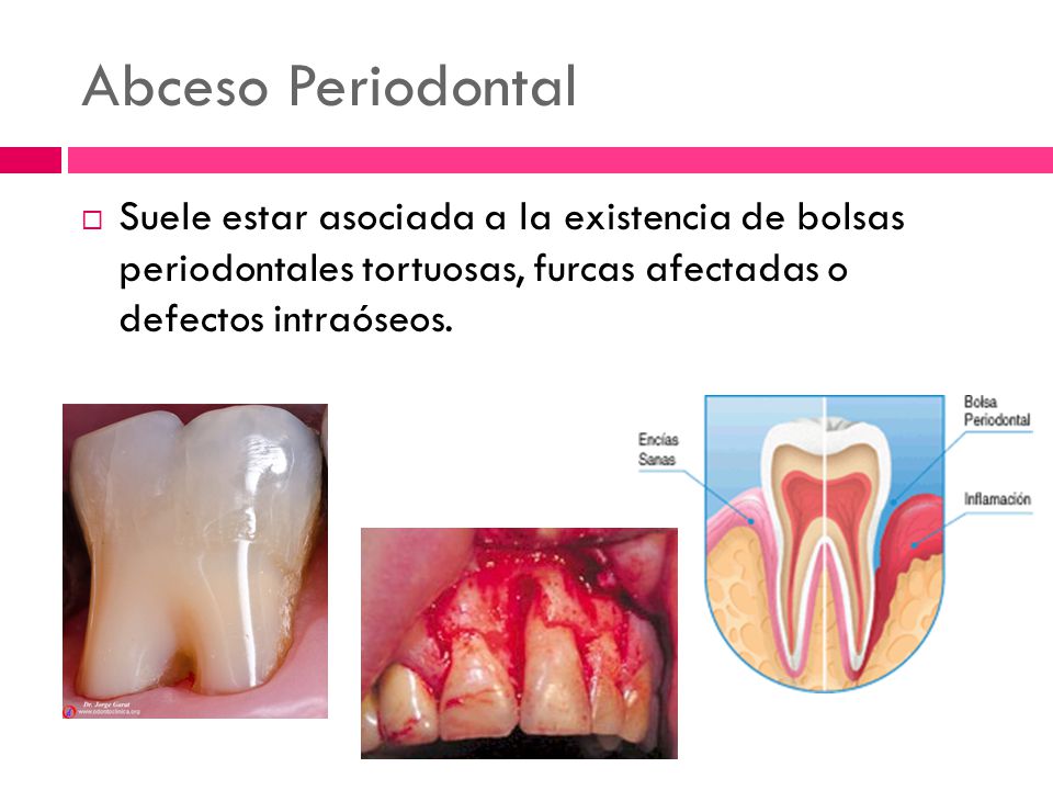 Abceso Periodontal Suele estar asociada a la existencia de bolsas periodontales tortuosas, furcas afectadas o defectos intraóseos.