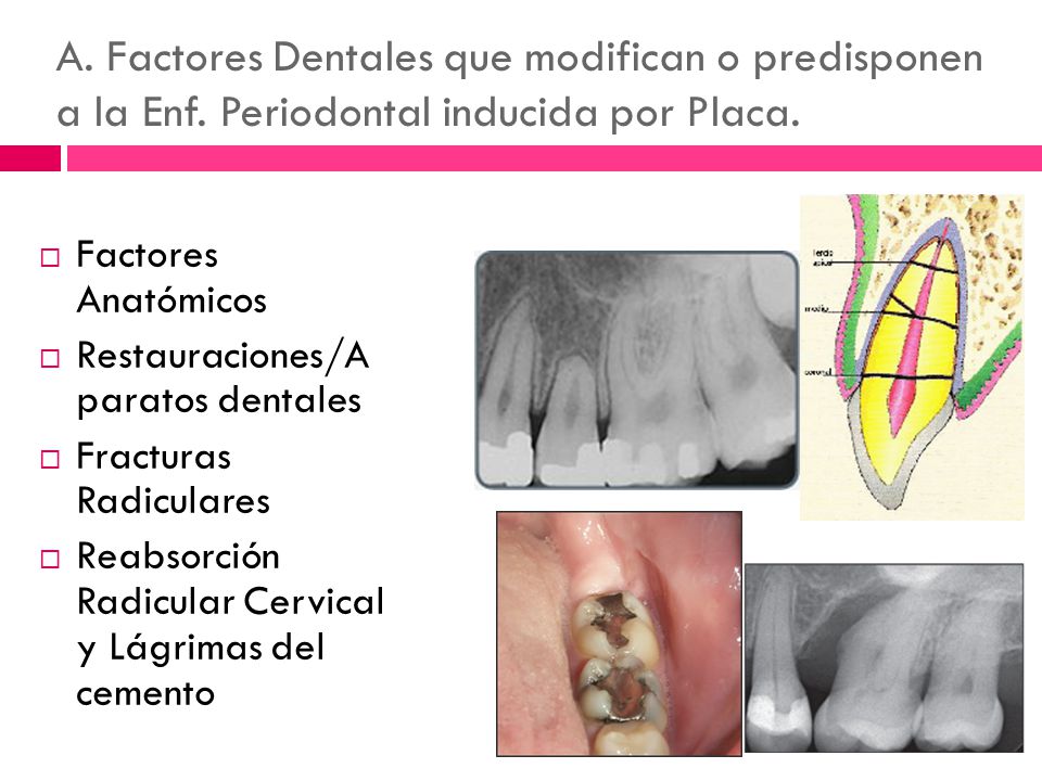 A. Factores Dentales que modifican o predisponen a la Enf