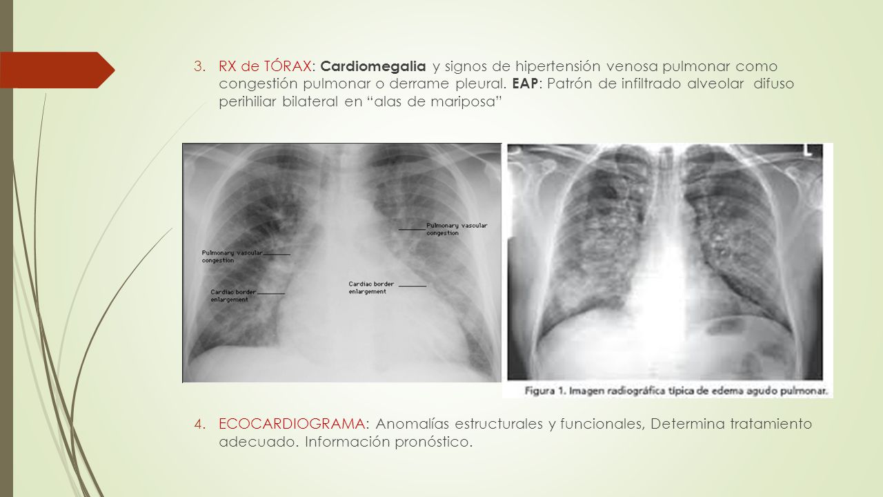 RX de TÓRAX: Cardiomegalia y signos de hipertensión venosa pulmonar como congestión pulmonar o derrame pleural. EAP: Patrón de infiltrado alveolar difuso perihiliar bilateral en alas de mariposa