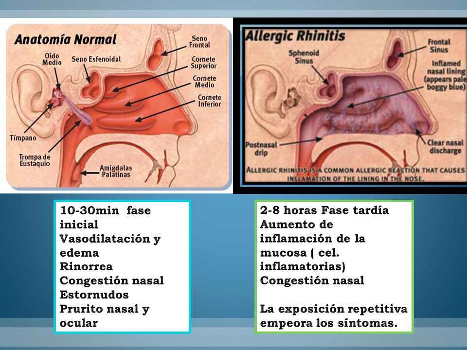 10-30min fase inicial Vasodilatación y edema. Rinorrea. Congestión nasal. Estornudos. Prurito nasal y ocular.