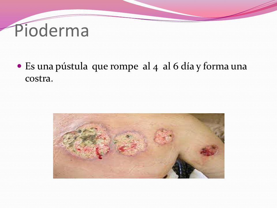 Pioderma Es una pústula que rompe al 4 al 6 día y forma una costra.