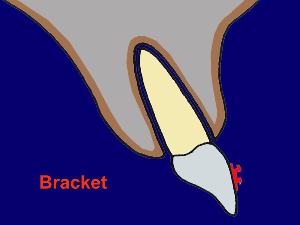 Bracket Corona Raíz Hueso esponjoso Hueso compacto