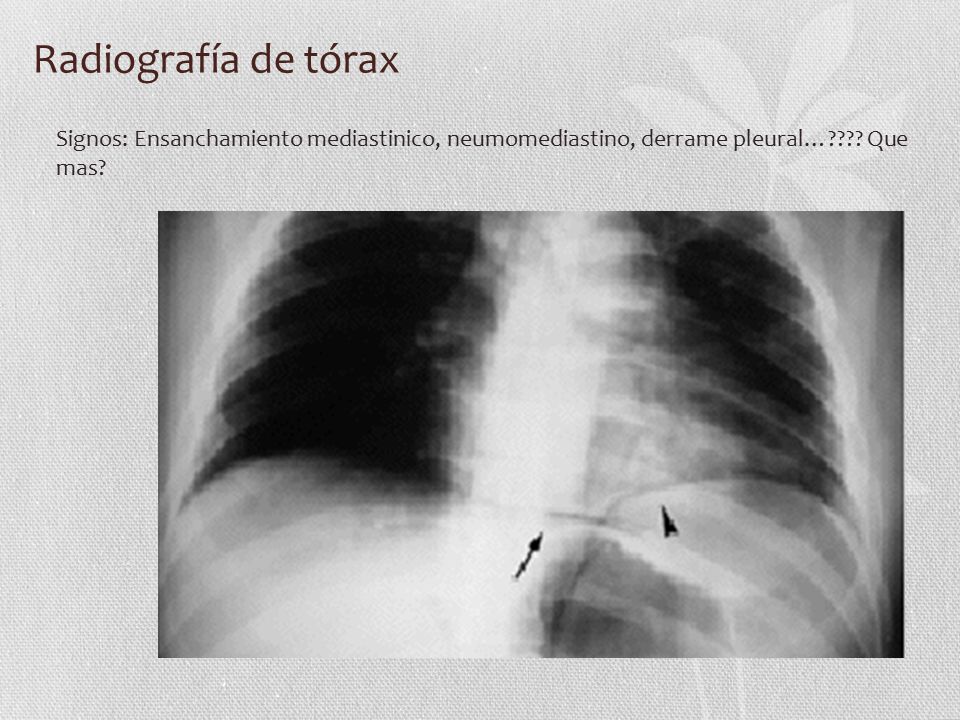 Radiografía de tórax Signos: Ensanchamiento mediastinico, neumomediastino, derrame pleural… .