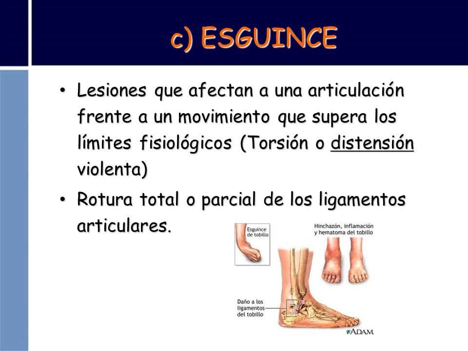c) ESGUINCE Lesiones que afectan a una articulación frente a un movimiento que supera los límites fisiológicos (Torsión o distensión violenta)