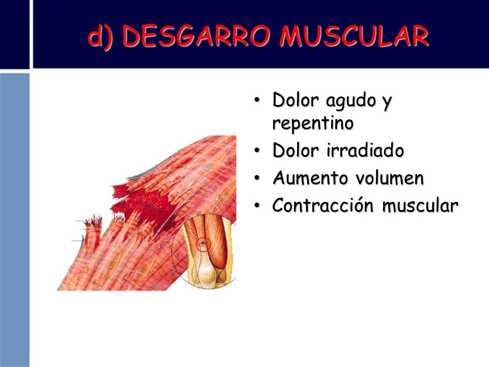 d) DESGARRO MUSCULAR Dolor agudo y repentino Dolor irradiado