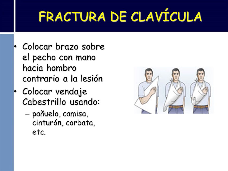 FRACTURA DE CLAVÍCULA Colocar brazo sobre el pecho con mano hacia hombro contrario a la lesión. Colocar vendaje Cabestrillo usando: