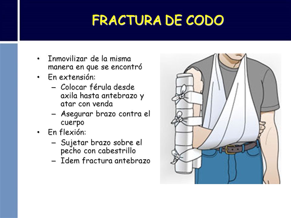 FRACTURA DE CODO Inmovilizar de la misma manera en que se encontró