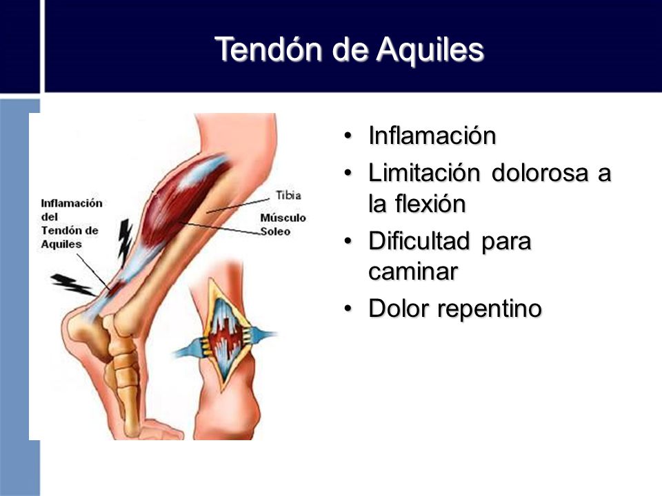Tendón de Aquiles Inflamación Limitación dolorosa a la flexión