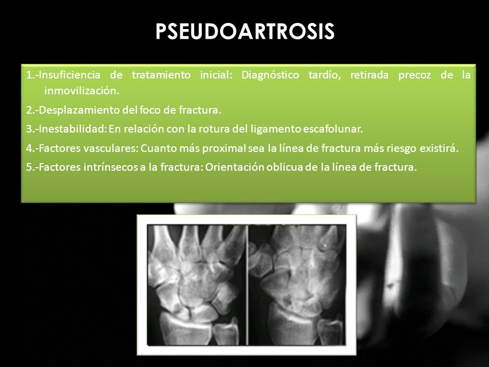 PSEUDOARTROSIS 1.-Insuficiencia de tratamiento inicial: Diagnóstico tardío, retirada precoz de la inmovilización.