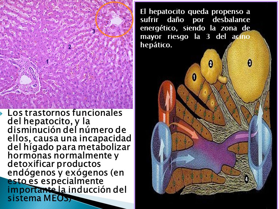 El hepatocito queda propenso a sufrir daño por desbalance energético, siendo la zona de mayor riesgo la 3 del acino hepático.