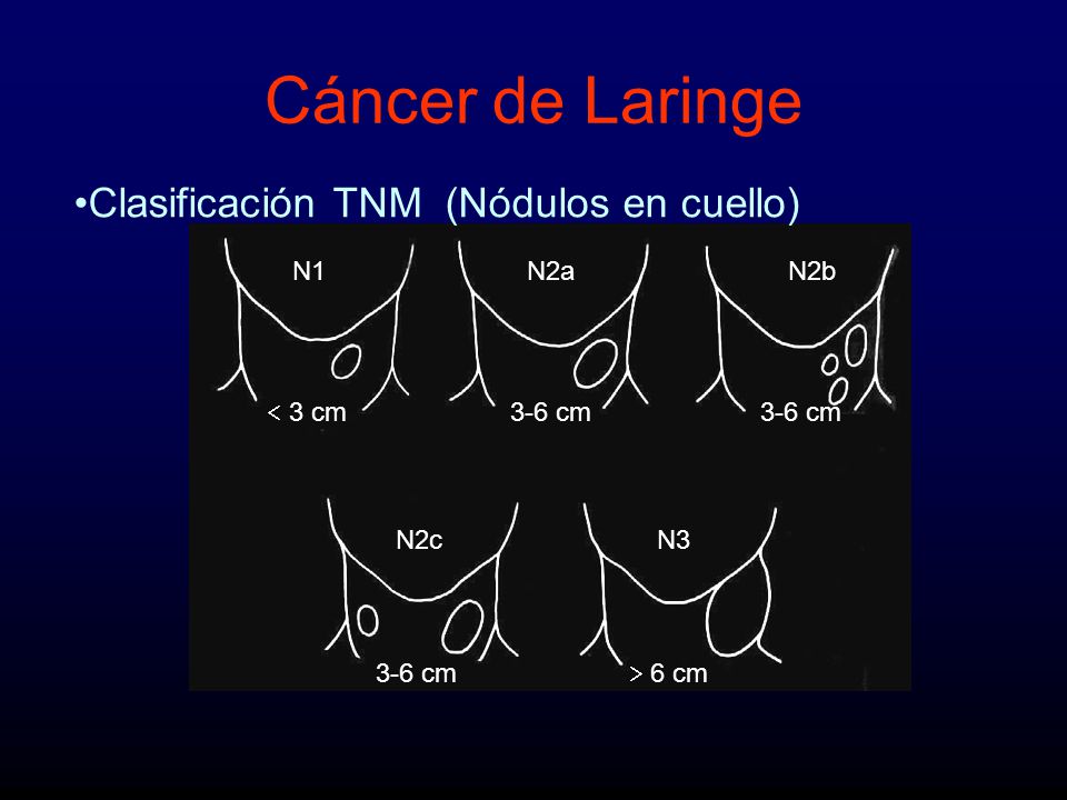 Cáncer de Laringe Clasificación TNM (Nódulos en cuello) N1 N2a N2b