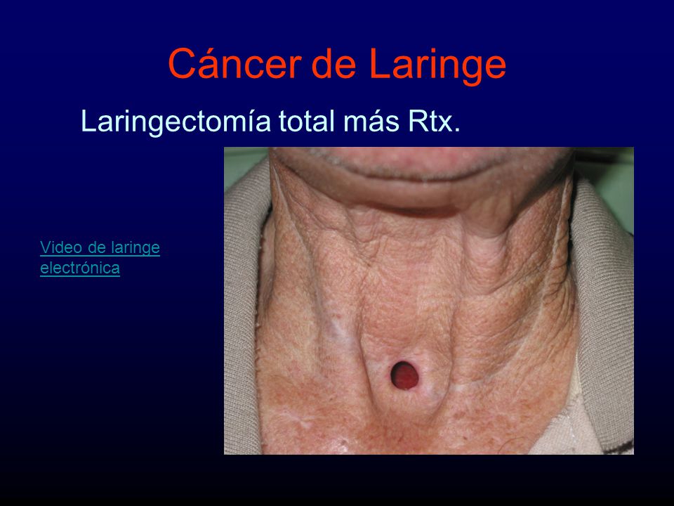 Cáncer de Laringe Laringectomía total más Rtx. Video de laringe