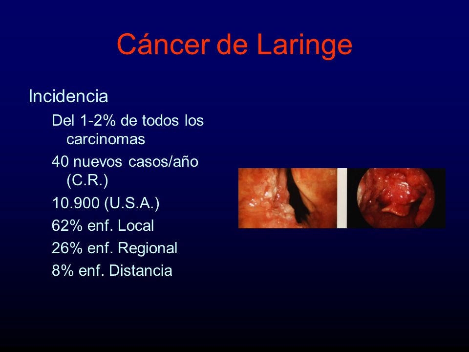 Cáncer de Laringe Incidencia Del 1-2% de todos los carcinomas