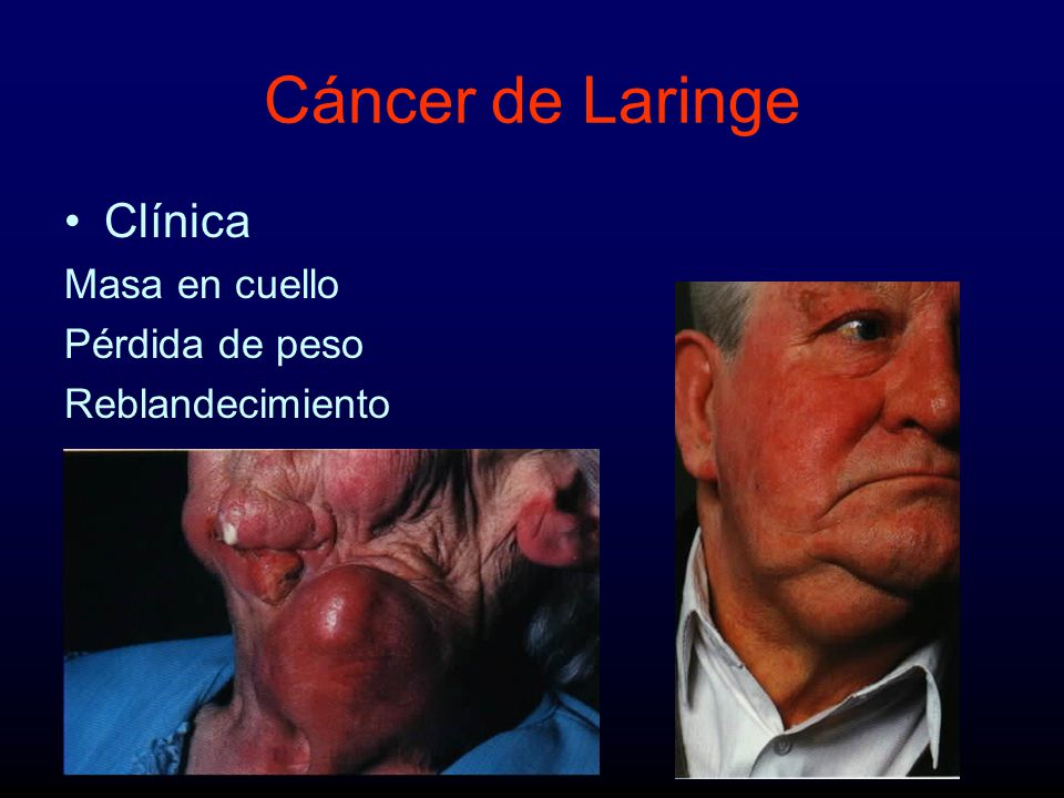Cáncer de Laringe Clínica Masa en cuello Pérdida de peso
