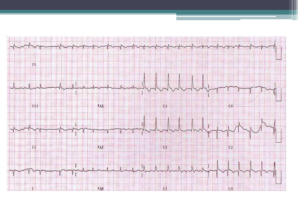 DIAGNÓSTICO ELECTROCARDIOGRÁFICO DE UNA ARRITMIA Para el análisis de una arritmia conviene seguir una sistemática, acá se propone la siguiente: - Identificar cuál es el ritmo subyacente - Cual es la frecuencia cardiaca.