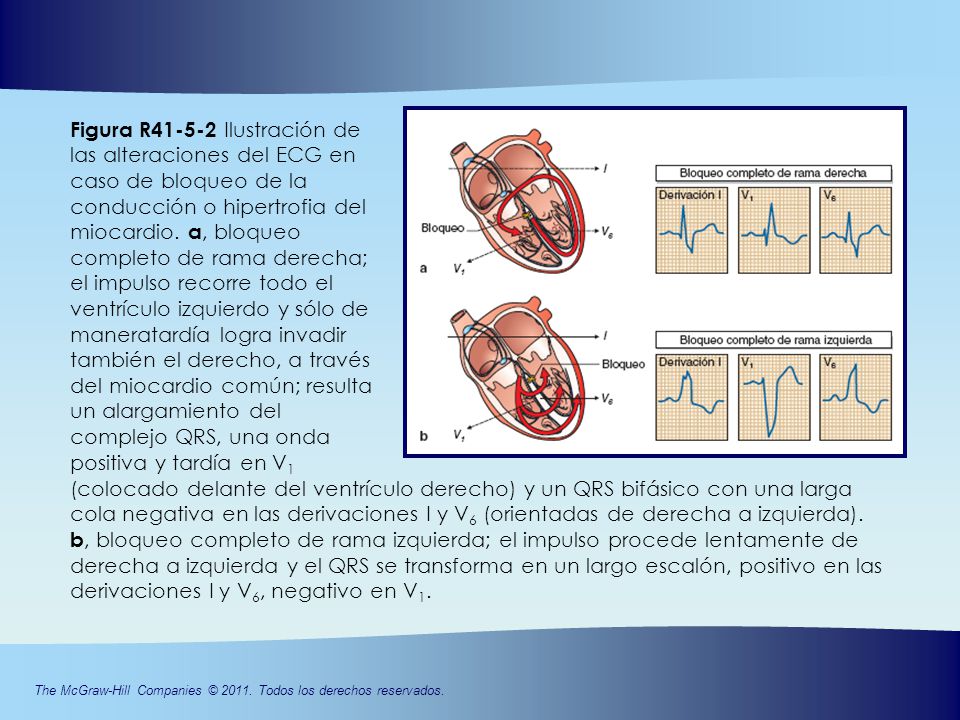 Figura R Ilustración de las alteraciones del ECG en caso de bloqueo de la conducción o hipertrofia del miocardio. a, bloqueo completo de rama derecha; el impulso recorre todo el ventrículo izquierdo y sólo de maneratardía logra invadir también el derecho, a través del miocardio común; resulta un alargamiento del complejo QRS, una onda positiva y tardía en V1
