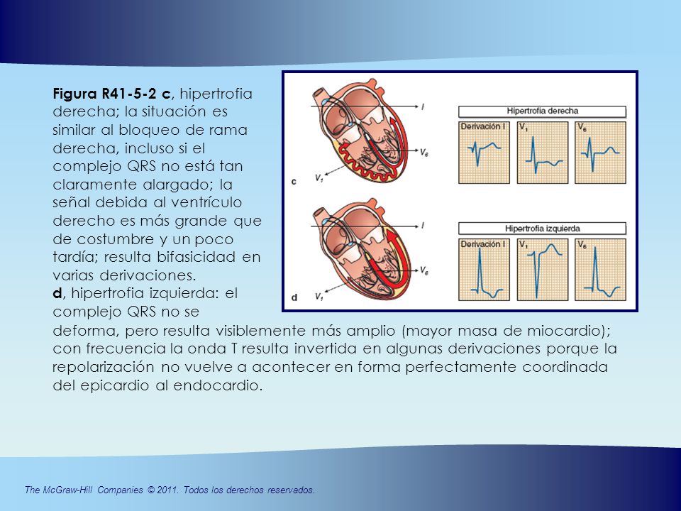Figura R c, hipertrofia derecha; la situación es similar al bloqueo de rama derecha, incluso si el complejo QRS no está tan claramente alargado; la señal debida al ventrículo derecho es más grande que de costumbre y un poco tardía; resulta bifasicidad en varias derivaciones. d, hipertrofia izquierda: el complejo QRS no se