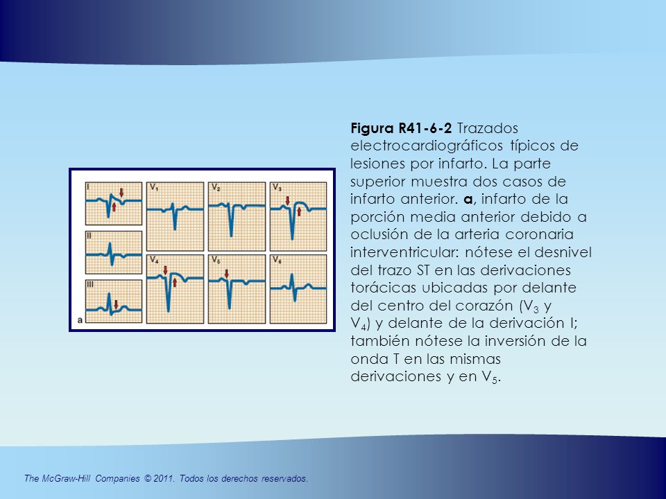 Figura R Trazados electrocardiográficos típicos de lesiones por infarto. La parte superior muestra dos casos de infarto anterior. a, infarto de la porción media anterior debido a oclusión de la arteria coronaria interventricular: nótese el desnivel del trazo ST en las derivaciones torácicas ubicadas por delante del centro del corazón (V3 y
