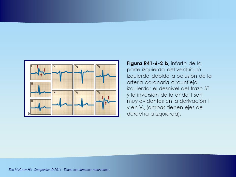 Figura R b, infarto de la parte izquierda del ventrículo izquierdo debido a oclusión de la arteria coronaria circunfleja izquierda: el desnivel del trazo ST y la inversión de la onda T son muy evidentes en la derivación I y en V6 (ambas tienen ejes de derecha a izquierda).
