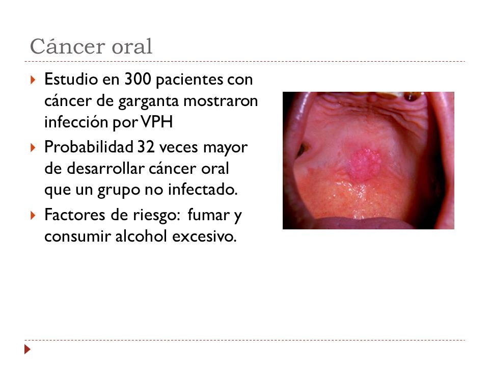 Cáncer oral Estudio en 300 pacientes con cáncer de garganta mostraron infección por VPH.