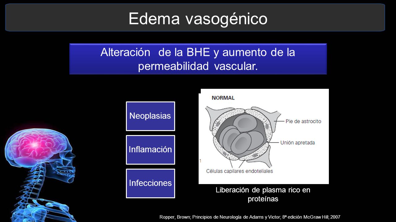 Edema vasogénico Alteración de la BHE y aumento de la permeabilidad vascular. Neoplasias. Inflamación.